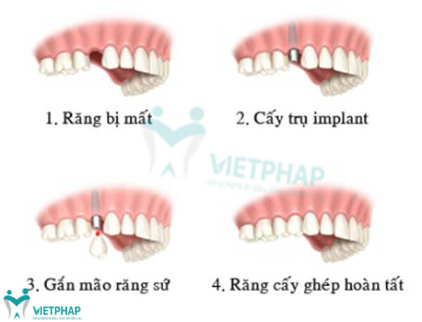 cay-ghep-rang-implant-gia-bao-nhieu (3)