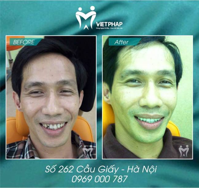 Hình ảnh khách hàng bọc răng sứ với chương trình khuyến mại răng nacera